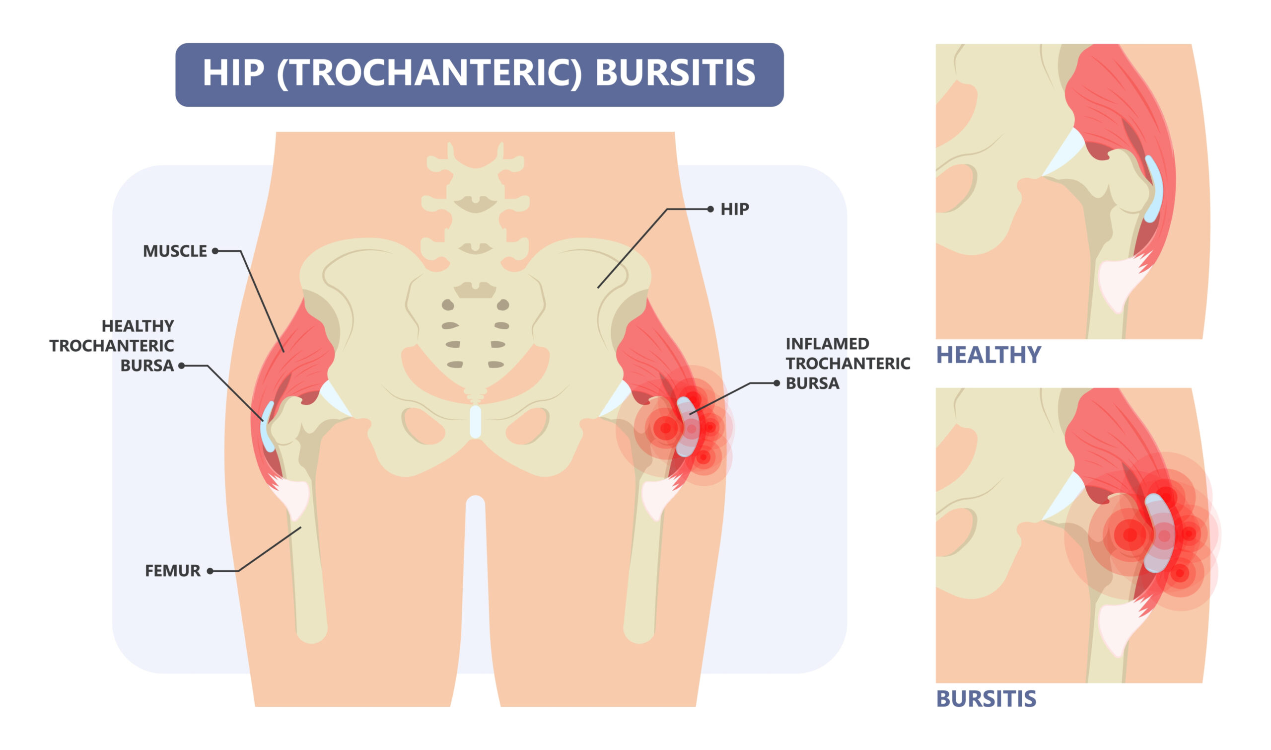 hip bursitis healthy and unhealthy